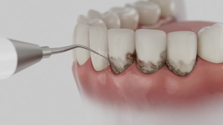 Trusted Wisdom Tooth Removal service in Borger, TX - Dentist Open Now